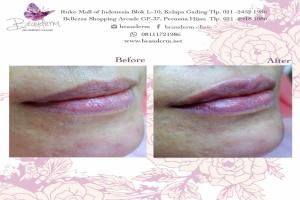 Lips Filler / Filler Bibir